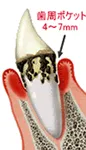 中度歯肉炎(歯肉ポケット 4~7mm)